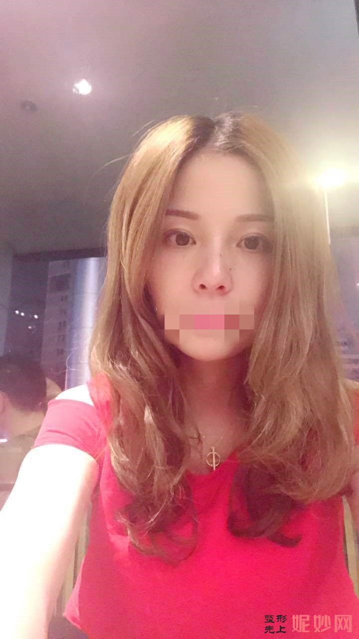 广州智媄医疗整形好吗？医生介绍~面部提拉手术案例分享+价格表