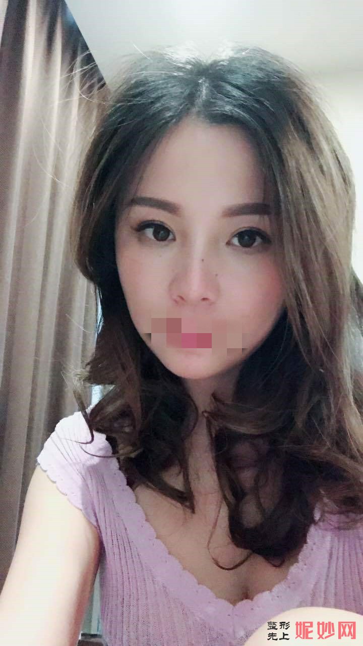 广州智媄医疗整形好吗？医生介绍~面部提拉手术案例分享+价格表
