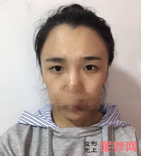 西京医院金长鑫双眼皮案例？医生介绍，双眼皮案例，价格表