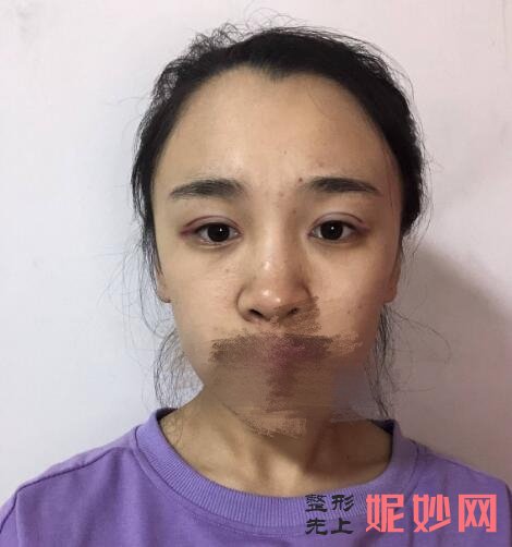 西京医院金长鑫双眼皮案例？医生介绍，双眼皮案例，价格表
