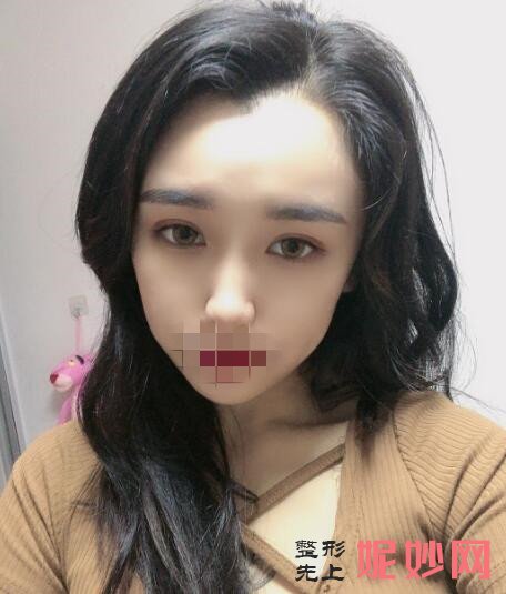 西京医院金长鑫双眼皮案例？医生介绍，双眼皮案例，价格表