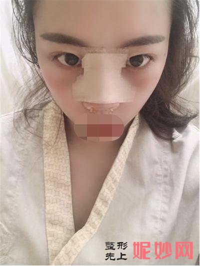 鼻翼缩小手术恢复
