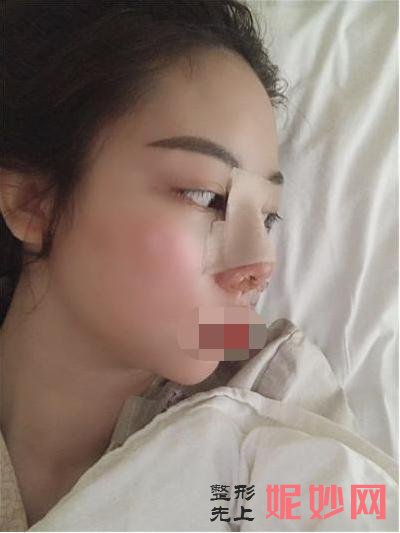 鼻翼缩小手术恢复