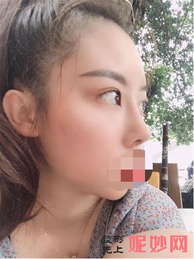 鼻翼缩小手术恢复