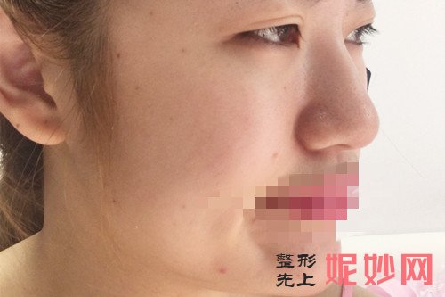 西安瘦脸*