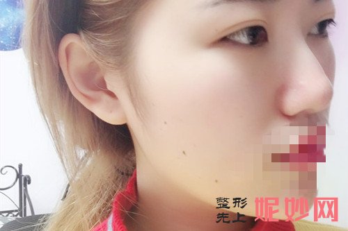 西安瘦脸*
