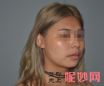 南京友谊金柱翰医生磨骨怎么样？附案例分析和价格表