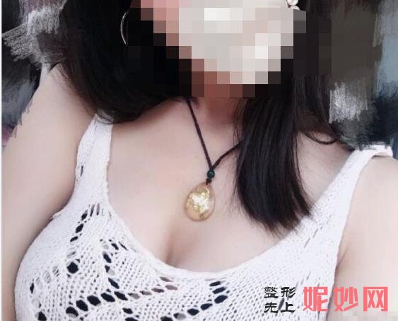 武汉中翰自体脂肪丰胸怎么样,安全吗？附案例分析及价格表！