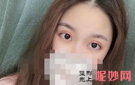 济南双眼皮哪家医院好？海峡美容医院闫迎军怎么样，附案例分析及价格表！