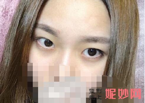 济南双眼皮哪家医院好？海峡美容医院闫迎军怎么样，附案例分析及价格表！