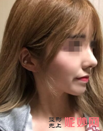 广州隆鼻比较好的专家有哪些？技术如何？