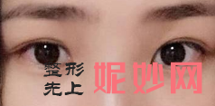 北京韩啸白永辉修复双眼皮怎么样？附案例分析和价格表