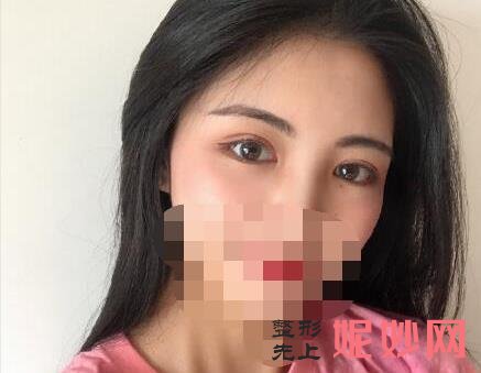 上海九院做上眼皮眼综合多少钱？附案例和价格表！