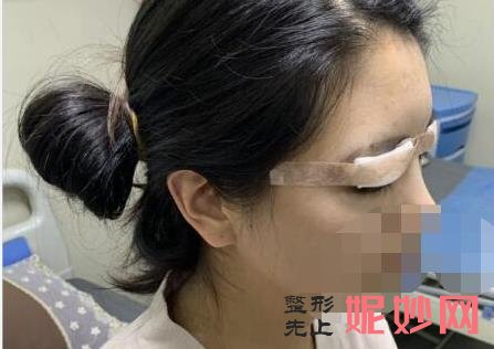 上海九院做上眼皮眼综合多少钱？附案例和价格表！