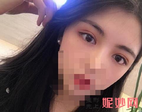 上海九院做上眼皮眼综合多少钱？附案例和价格表！