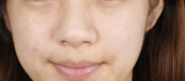 广州伊丽莎白医疗美容怎么样？附案例分析和价格表