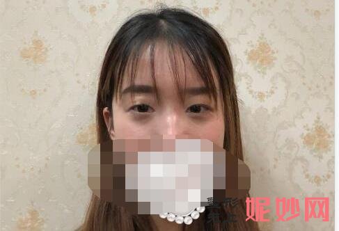 深圳米兰柏羽高新医院做双眼皮怎么样？附案例分享和价格表！