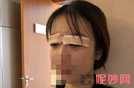 深圳米兰柏羽高新医院做双眼皮怎么样？附案例分享和价格表！