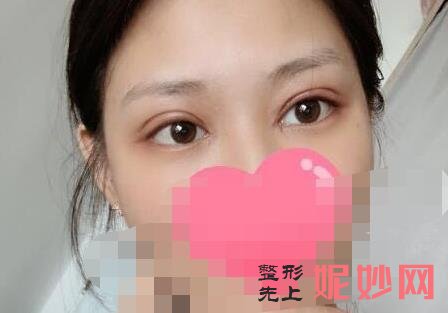 昆明娇点整形医疗美容医院做双眼皮怎么样？附双眼皮案例和价格表！