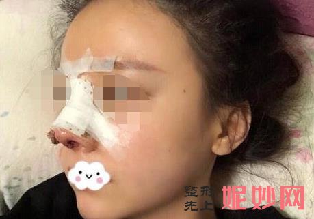 昆明韩辰医疗美容医院做隆鼻好吗？附隆鼻案例和价格表！