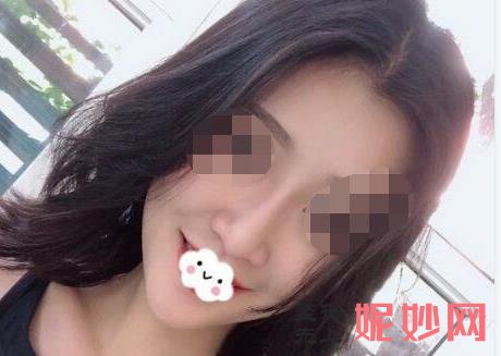 昆明韩辰医疗美容医院做隆鼻好吗？附隆鼻案例和价格表！