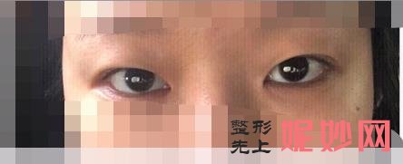 昆明卓星医疗美容医院怎么样？做双眼皮好不好？附双眼皮案例和价格表！