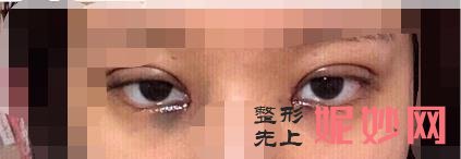 昆明卓星医疗美容医院怎么样？做双眼皮好不好？附双眼皮案例和价格表！