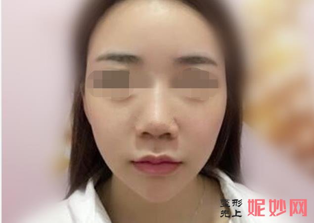 广西爱思特整形外科医院做隆鼻怎么样？医院介绍附隆鼻案例和价格表！