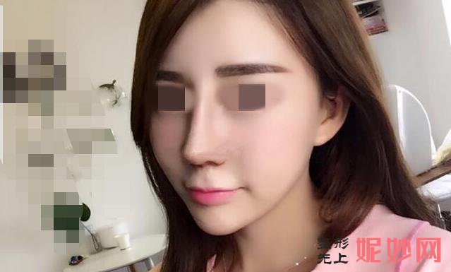 广西爱思特整形外科医院做隆鼻怎么样？医院介绍附隆鼻案例和价格表！