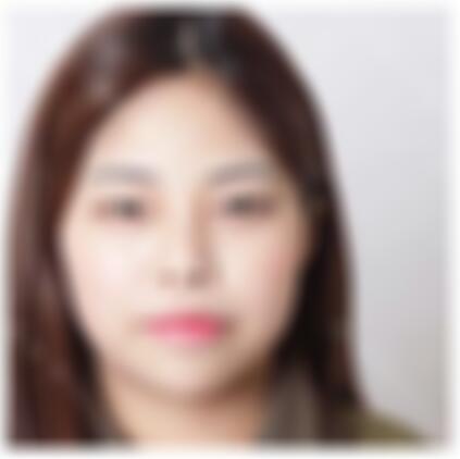 北京东方瑞丽医疗美容门诊部怎么样?附隆鼻术后恢复效果图+价格表