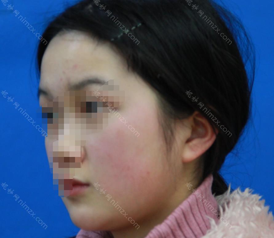 上海九院刘滢医生怎么样？个人介绍+除皱案例图分享