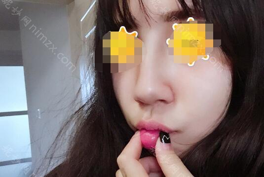 上海九院王琛做肋骨隆鼻好吗？技术可靠吗？附上术后恢复图分享