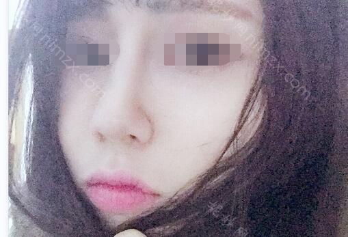 上海九院王琛做肋骨隆鼻好吗？技术可靠吗？附上术后恢复图分享