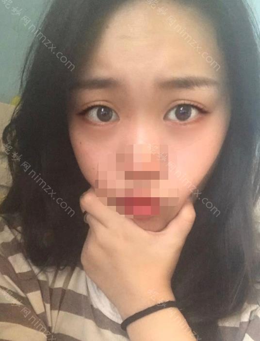 上海九院张路割眼袋怎么样？医生的成就+去眼袋案例对比图
