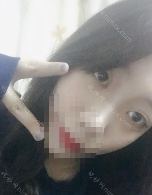 上海九院张路割眼袋怎么样？医生的成就+去眼袋案例对比图