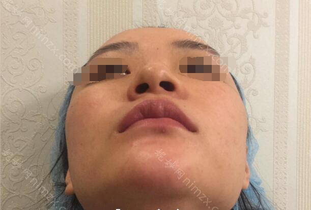 上海九院祝联隆鼻怎么样？价格多少钱？戳进来看看吧