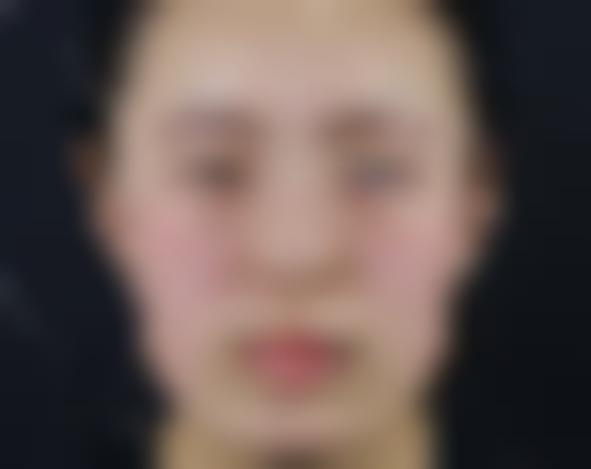 郑州唐美人医疗整形美容医院怎么样？附上真人实拍下颌角磨骨案例图