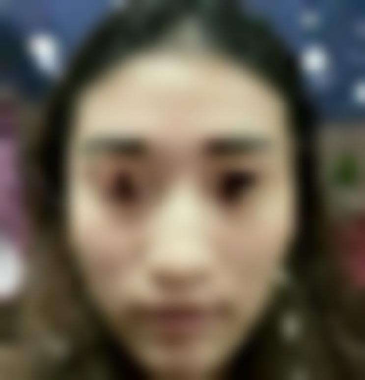 上海雅尚整形医院地址在哪里？在医院做丰太阳穴真实案例分享！