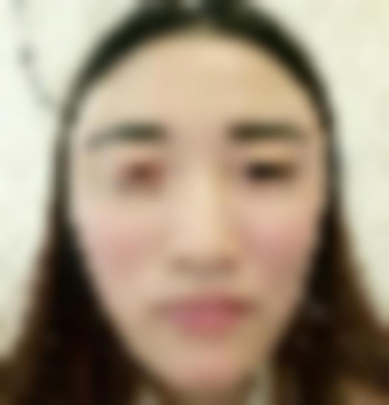 上海雅尚整形医院地址在哪里？在医院做丰太阳穴真实案例分享！