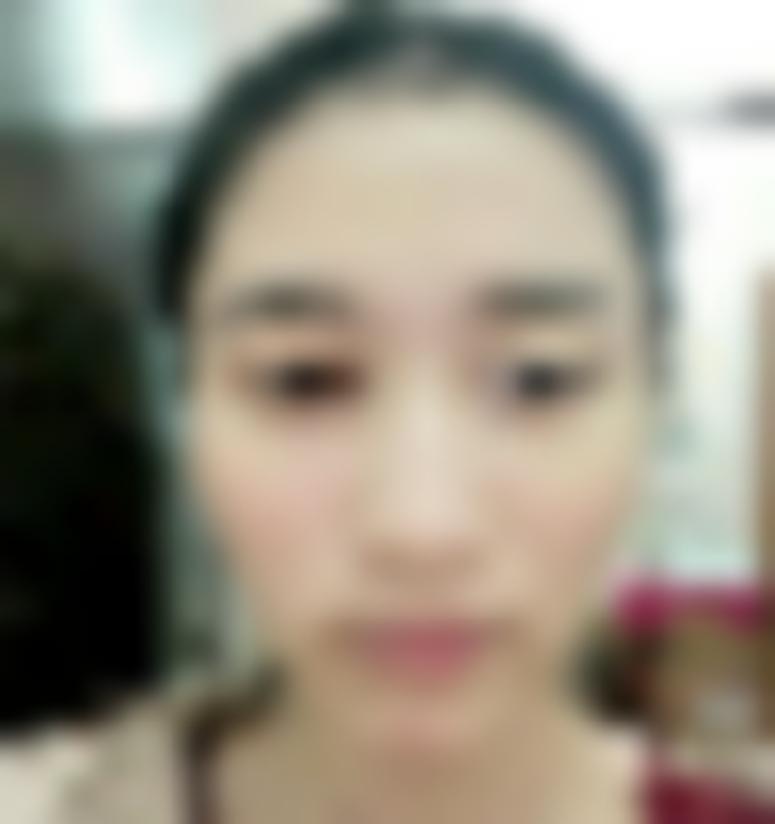 上海雅尚整形医院地址在哪里？在医院做丰太阳穴真实案例分享！