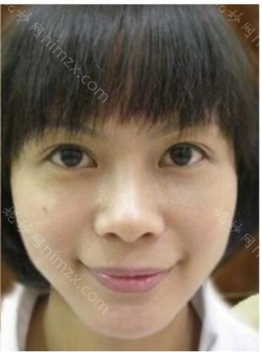 祛眼袋多少钱?附术后恢复过程介绍+较新价格表一览