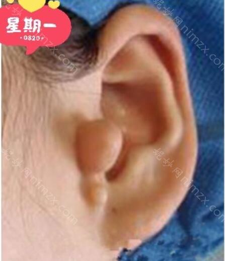 耳朵可以做整形术吗?附整形手术案例介绍_价目表查询