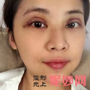 武汉美尚美医疗美容医院李相奇医生怎么样_蛋白线埋线提升颈部怎么样_坐诊时间