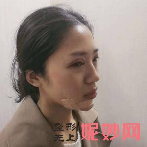 上海美莱医疗美容门诊部袁玉坤医生好不好_颧骨垫高好不好
