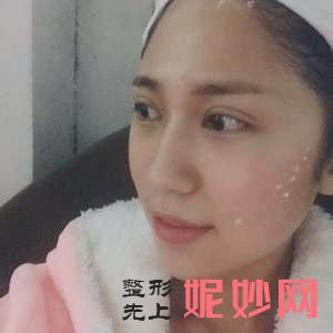 上海美莱医疗美容门诊部袁玉坤医生好不好_颧骨垫高好不好