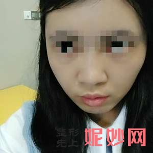 上海美莱医疗美容门诊部王琳医生怎么样_E-MAX整形怎么样