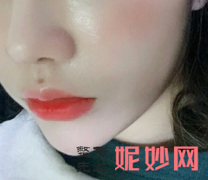 苏州美贝尔整形美容医院梁志伟医生技术怎么样_除皱针缩鼻头技术怎么样_坐诊时间_案例前后对比照