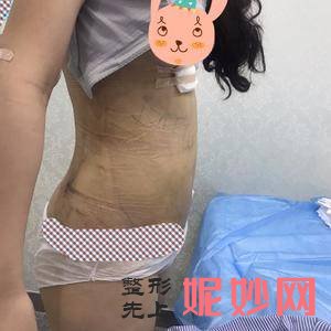 杭州美莱医疗美容医院胡朝霞医生怎么样_超微小气泡怎么样_坐诊时间_案例分享
