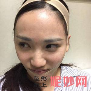 广州紫馨韩国定制整形美容洪星杓医生好不好_副耳整形好不好