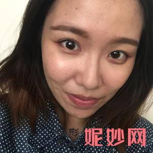 北京协和医院整形美容科王阳医生技术怎么样_Mega隐形瓷贴面技术怎么样